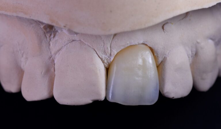 Korona licowana ceramika