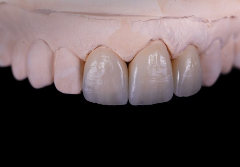 Korony licowane ceramika 