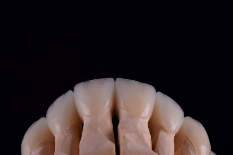 Korony licowane ceramika 