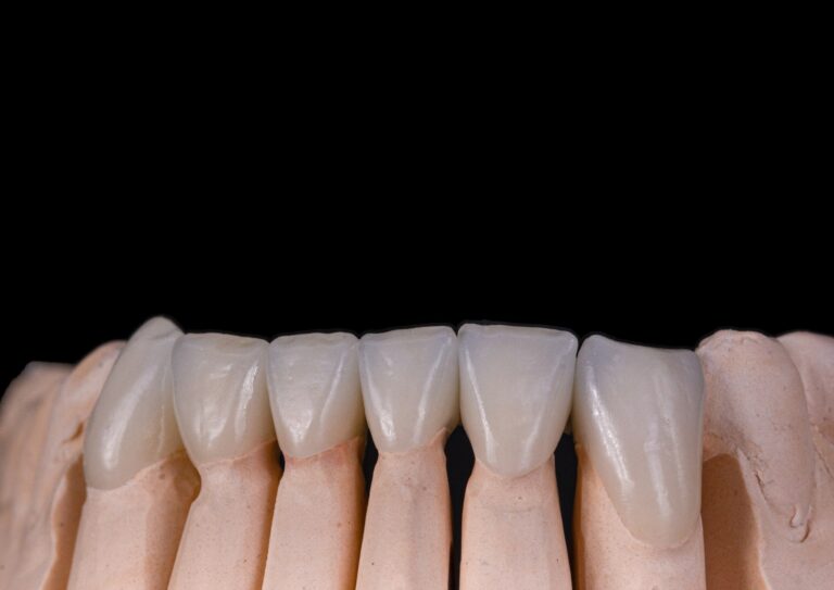 Korony licowane ceramika 