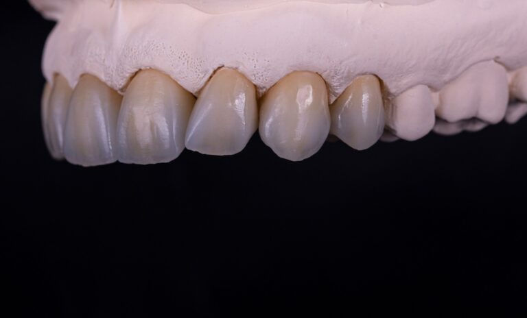 Korony licowane ceramika 