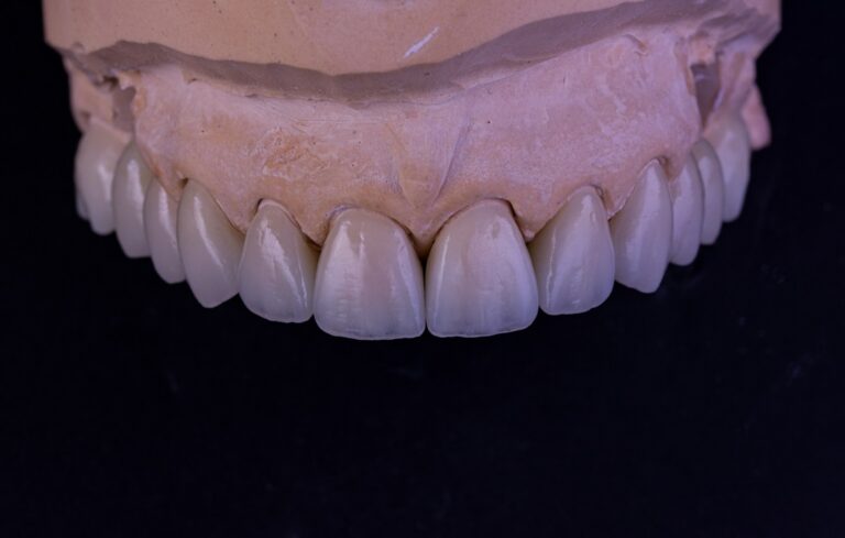 Korony licowane ceramika 